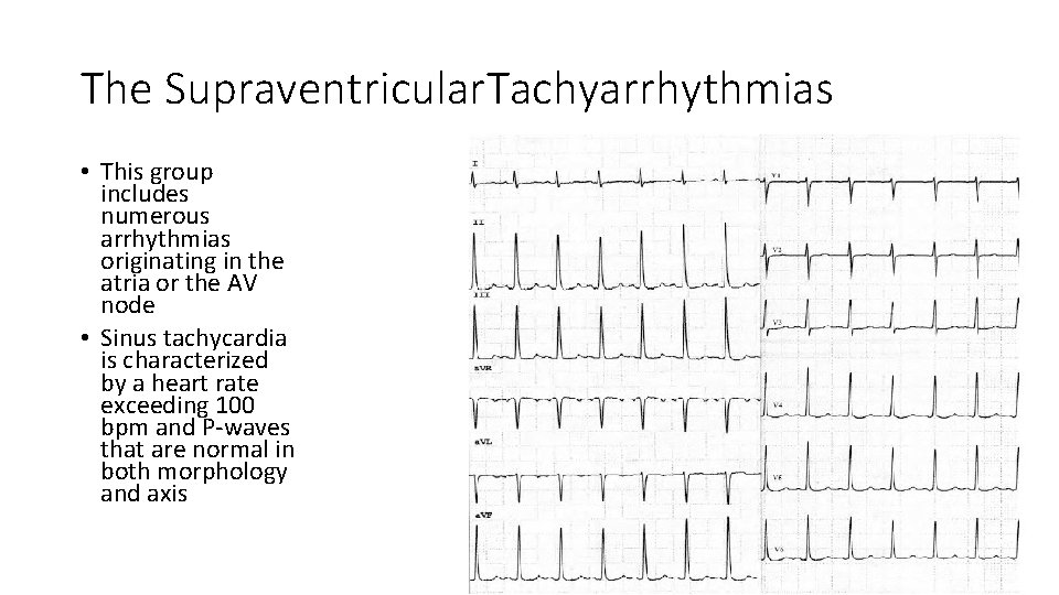 The Supraventricular. Tachyarrhythmias • This group includes numerous arrhythmias originating in the atria or