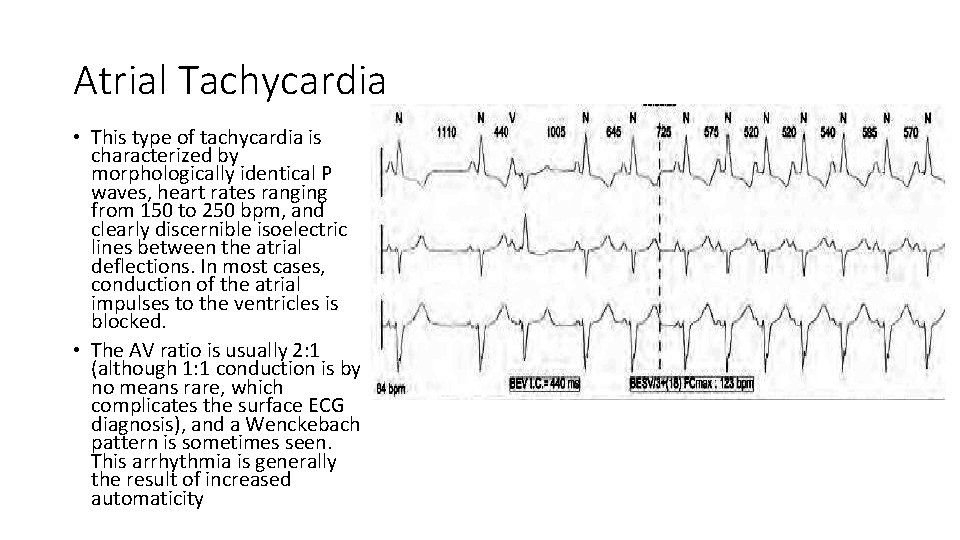 Atrial Tachycardia • This type of tachycardia is characterized by morphologically identical P waves,