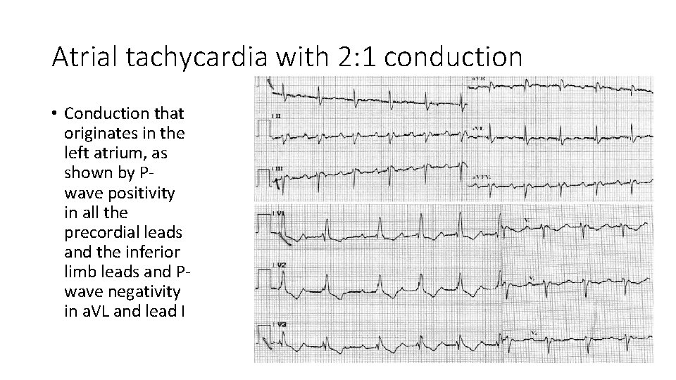 Atrial tachycardia with 2: 1 conduction • Conduction that originates in the left atrium,