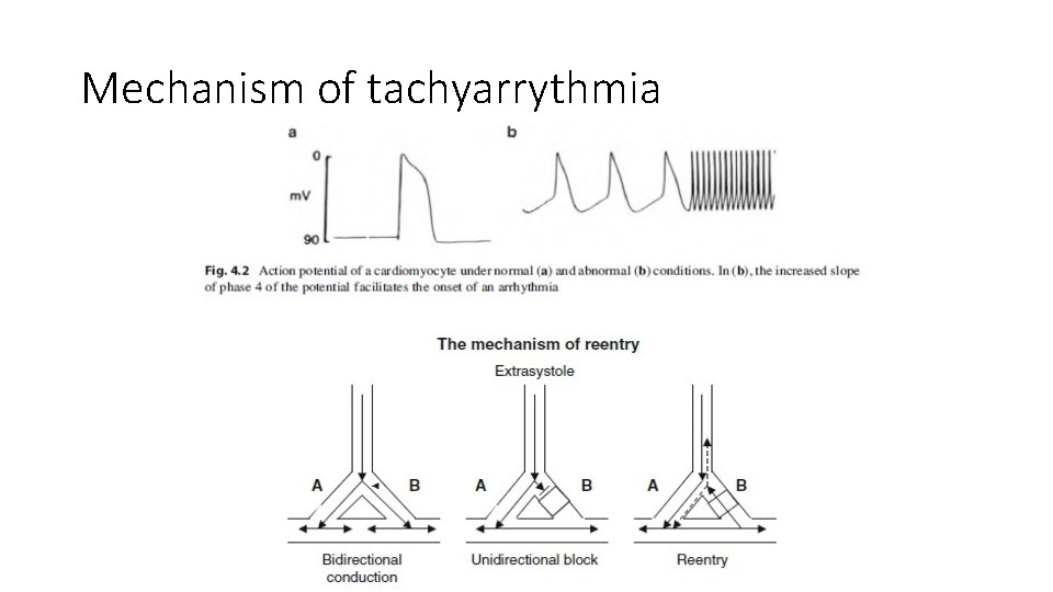 Mechanism of tachyarrythmia 