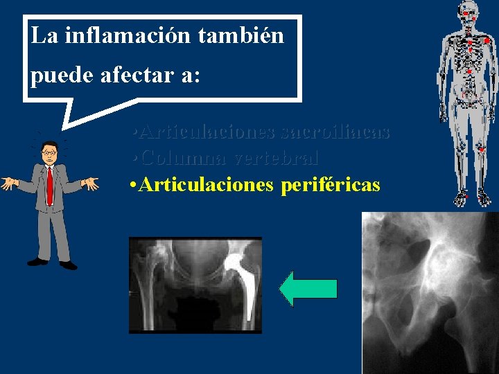 La inflamación también puede afectar a: • Articulaciones sacroiliacas • Columna vertebral • Articulaciones