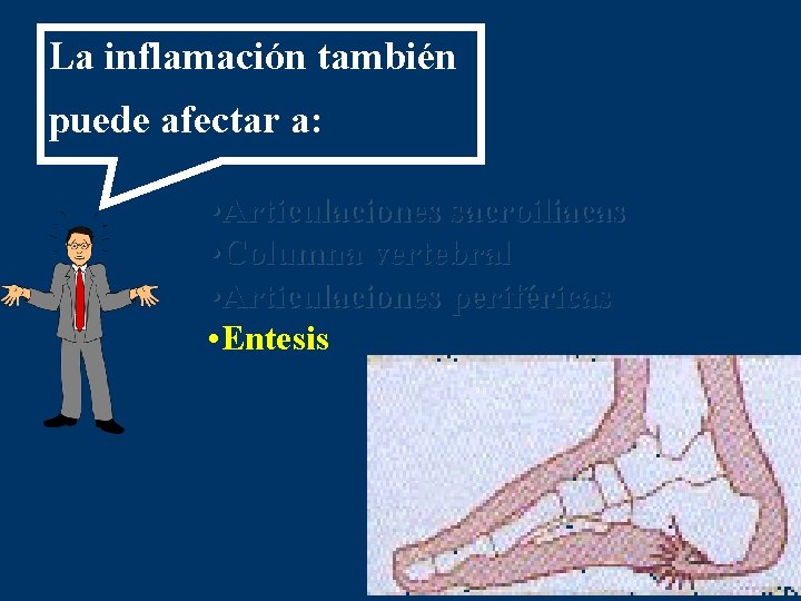 La inflamación también puede afectar a: • Articulaciones sacroiliacas • Columna vertebral • Articulaciones