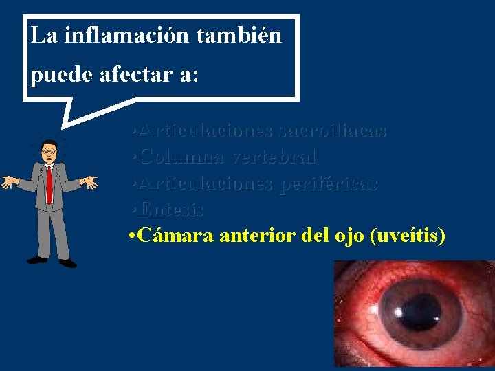 La inflamación también puede afectar a: • Articulaciones sacroiliacas • Columna vertebral • Articulaciones