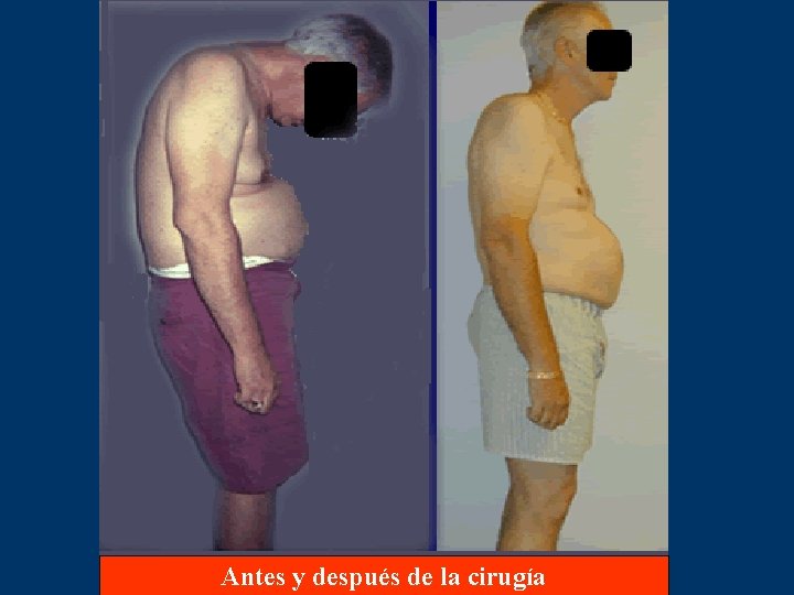 Antes y después de la cirugía 