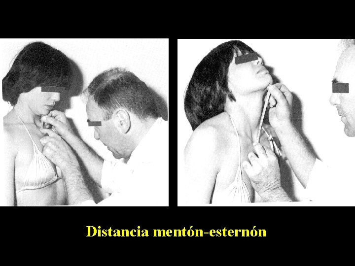 Distancia mentón-esternón 