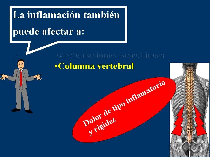 La inflamación también puede afectar a: • Articulaciones sacroiliacas • Columna vertebral o i