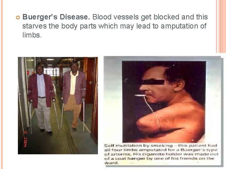  Buerger’s Disease. Blood vessels get blocked and this starves the body parts which