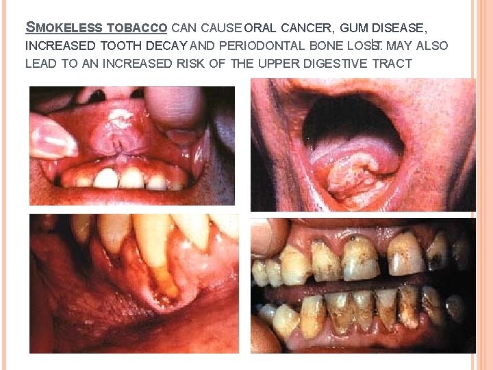 SMOKELESS TOBACCO CAN CAUSE ORAL CANCER, GUM DISEASE, INCREASED TOOTH DECAY AND PERIODONTAL BONE