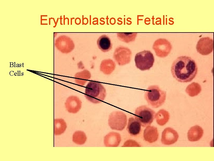 Erythroblastosis Fetalis Blast Cells 