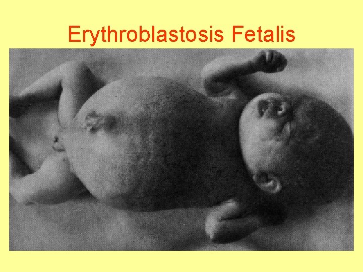 Erythroblastosis Fetalis 