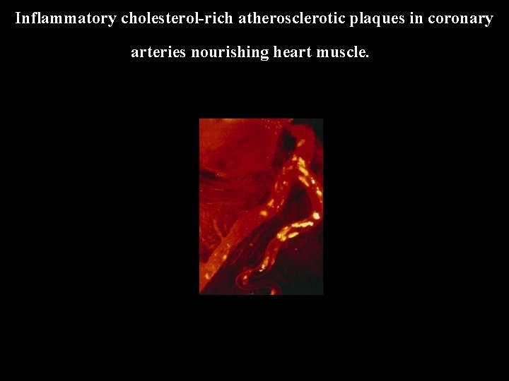 Inflammatory cholesterol-rich atherosclerotic plaques in coronary arteries nourishing heart muscle. 