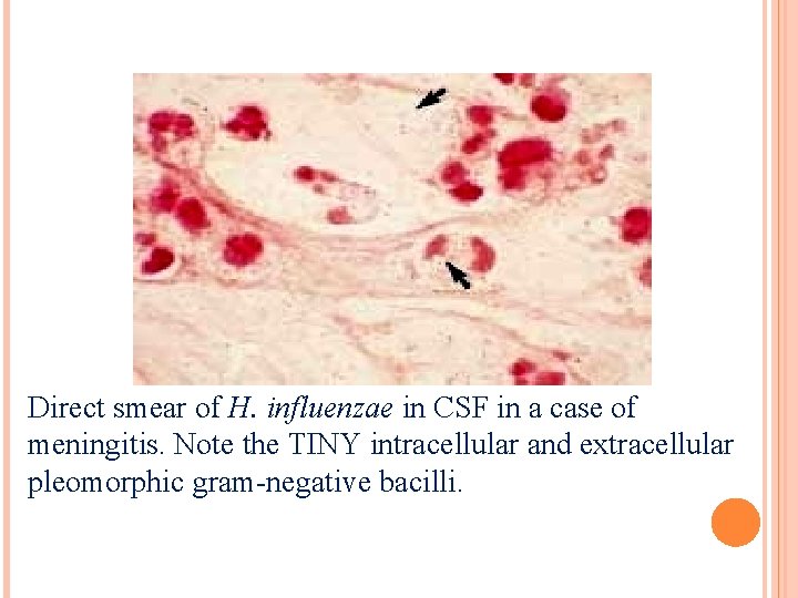 Direct smear of H. influenzae in CSF in a case of meningitis. Note the