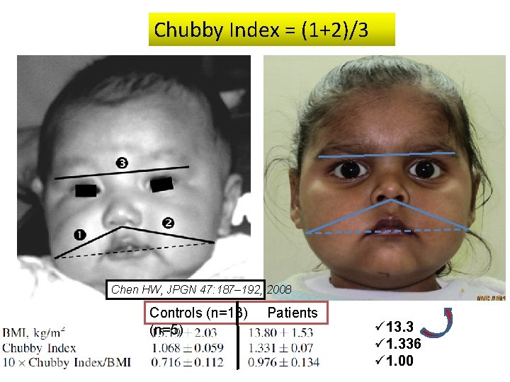 Chubby Index = (1+2)/3 Chen HW, JPGN 47: 187– 192, 2008 Controls (n=13) (n=5)