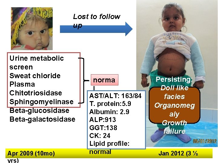 Lost to follow up Urine metabolic screen Sweat chloride Plasma Chitotriosidase Sphingomyelinase Beta-glucosidase Beta-galactosidase