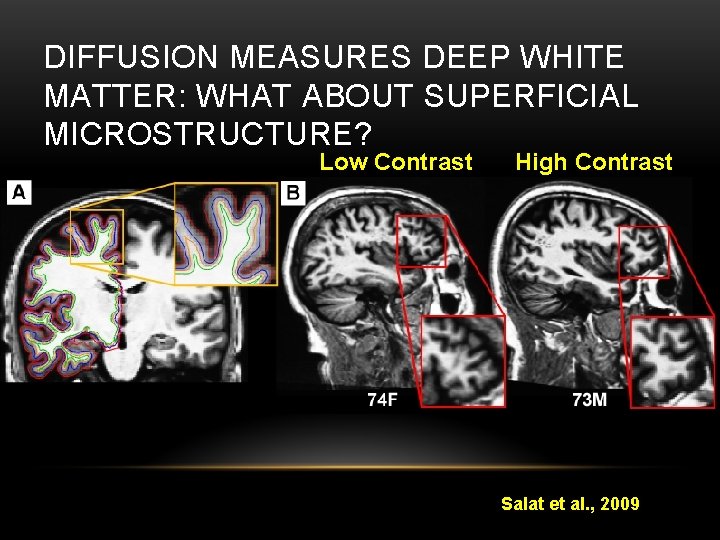 DIFFUSION MEASURES DEEP WHITE MATTER: WHAT ABOUT SUPERFICIAL MICROSTRUCTURE? Low Contrast High Contrast Salat