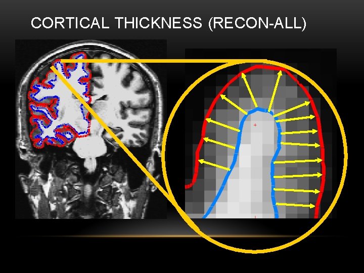 CORTICAL THICKNESS (RECON-ALL) 