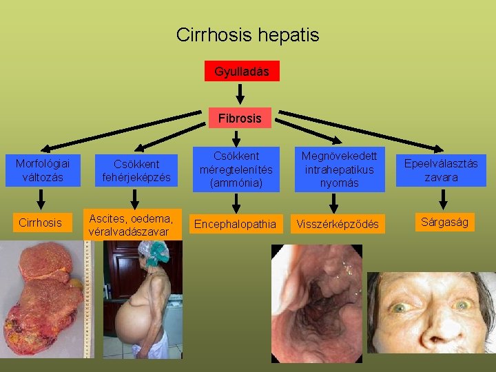 Cirrhosis hepatis Gyulladás Fibrosis Morfológiai változás Cirrhosis Csökkent fehérjeképzés Ascites, oedema, véralvadászavar Csökkent méregtelenítés