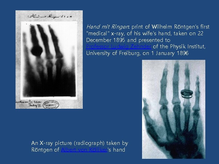 Hand mit Ringen: print of Wilhelm Röntgen's first "medical" x-ray, of his wife's hand,