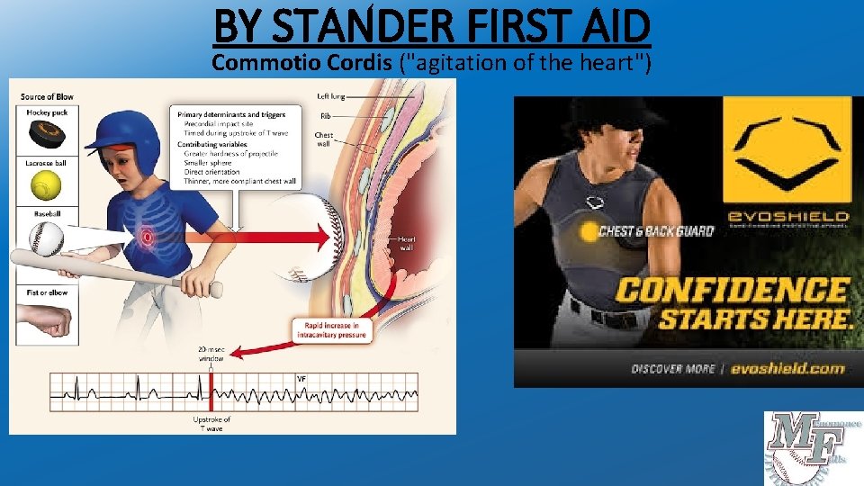 BY STANDER FIRST AID Commotio Cordis ("agitation of the heart") 