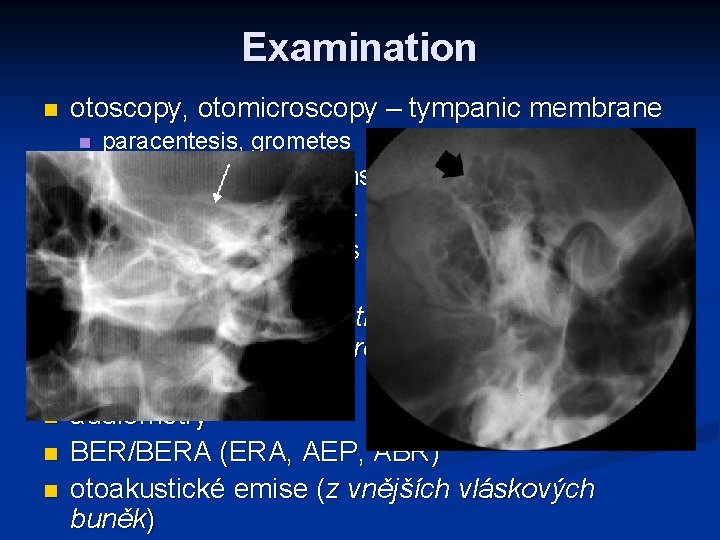 Examination n otoscopy, otomicroscopy – tympanic membrane n n n n paracentesis, grometes tuning Examination n otoscopy, otomicroscopy – tympanic membrane n n n n paracentesis, grometes tuning