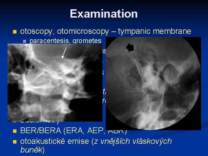 Examination n otoscopy, otomicroscopy – tympanic membrane n n n n paracentesis, grometes tuning