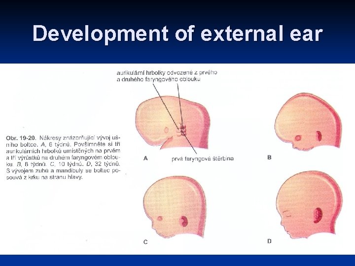 Development of external ear Development of external ear