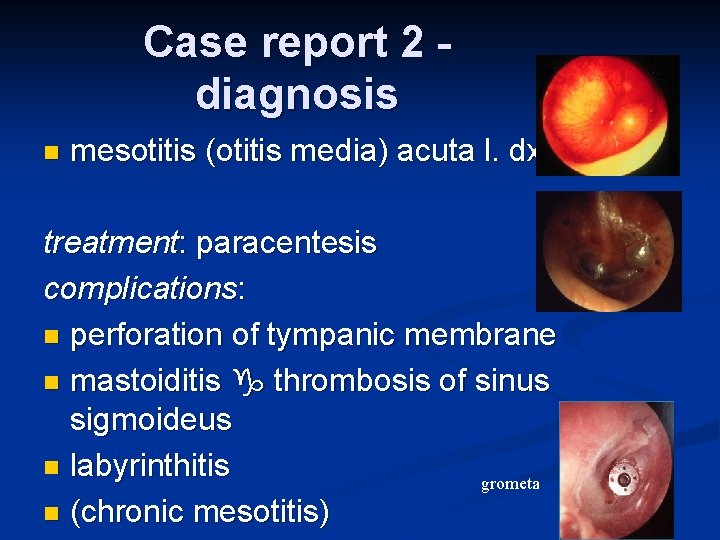 Case report 2 diagnosis n mesotitis (otitis media) acuta l. dx. treatment: paracentesis complications: