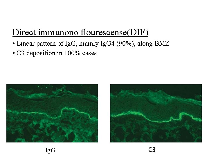 Direct immunono flourescense(DIF) • Linear pattern of Ig. G, mainly Ig. G 4 (90%),