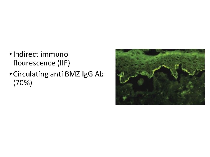  • Indirect immuno flourescence (IIF) • Circulating anti BMZ Ig. G Ab (70%)