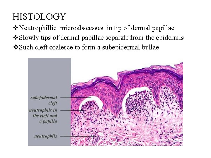 HISTOLOGY v. Neutrophillic microabscesses in tip of dermal papillae v. Slowly tips of dermal