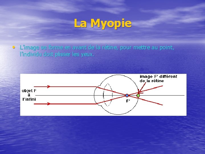 La Myopie • L’image se forme en avant de la rétine, pour mettre au