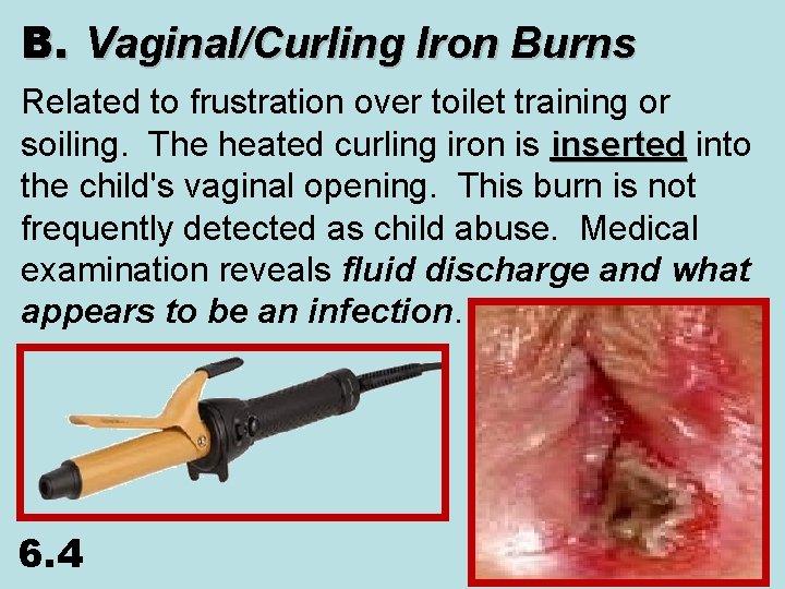 B. Vaginal/Curling Iron Burns Related to frustration over toilet training or soiling. The heated