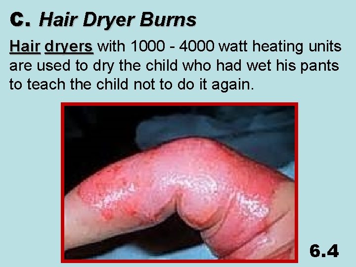C. Hair Dryer Burns Hair dryers with 1000 - 4000 watt heating units are