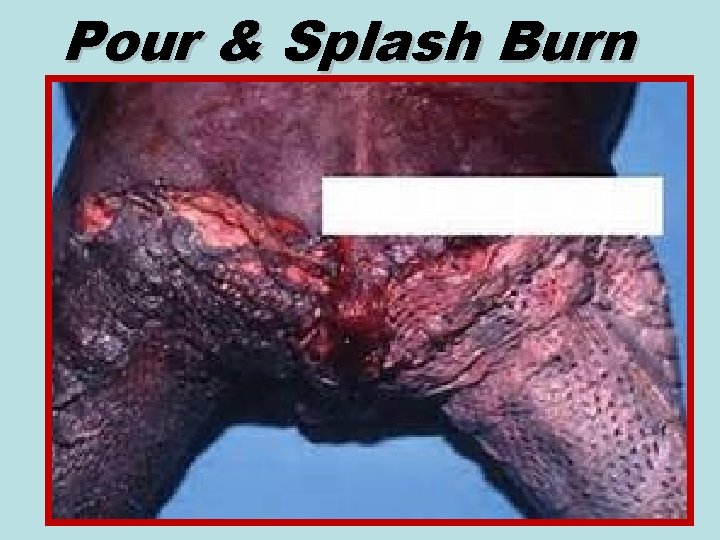 Pour & Splash Burn 