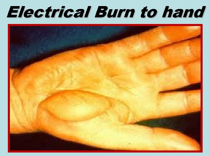 Electrical Burn to hand 