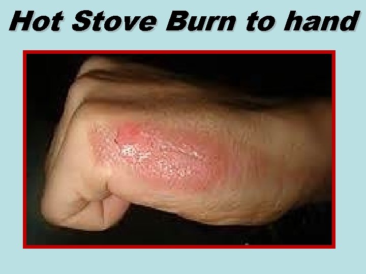 Hot Stove Burn to hand 