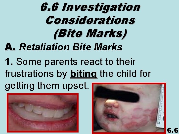 6. 6 Investigation Considerations (Bite Marks) A. Retaliation Bite Marks 1. Some parents react