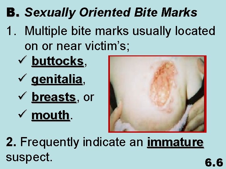B. Sexually Oriented Bite Marks 1. Multiple bite marks usually located on or near