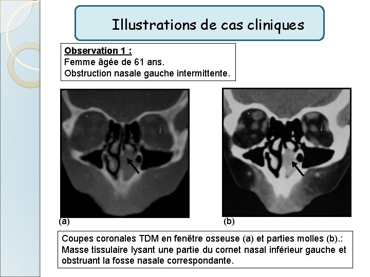 Illustrations de cas cliniques Observation 1 : Femme âgée de 61 ans. Obstruction nasale