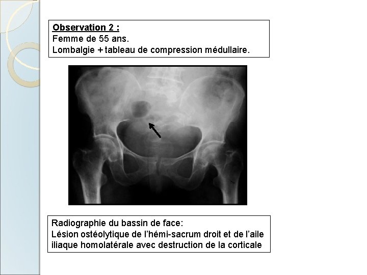 Observation 2 : Femme de 55 ans. Lombalgie + tableau de compression médullaire. Radiographie