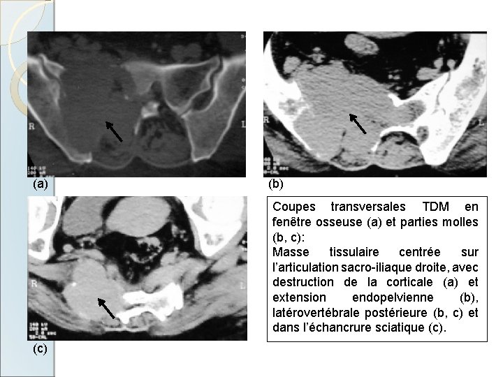 (a) (b) Coupes transversales TDM en fenêtre osseuse (a) et parties molles (b, c):