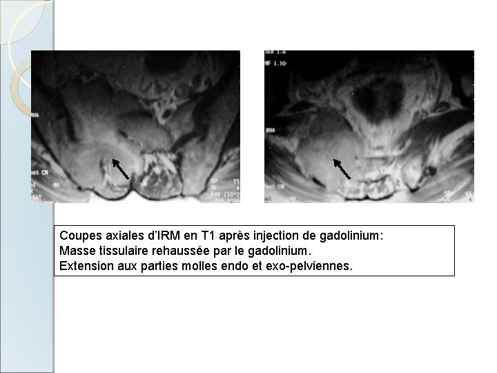 Coupes axiales d’IRM en T 1 après injection de gadolinium: Masse tissulaire rehaussée par