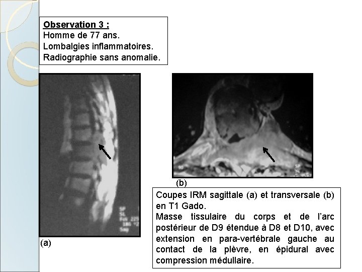 Observation 3 : Homme de 77 ans. Lombalgies inflammatoires. Radiographie sans anomalie. (a) (b)