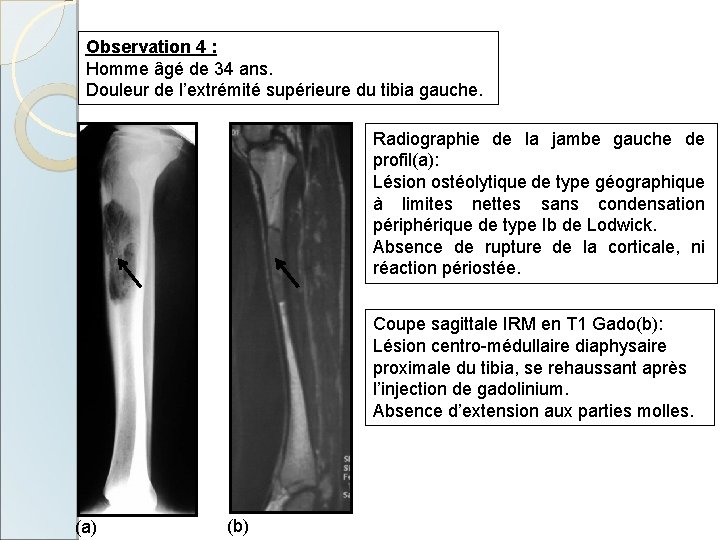 Observation 4 : Homme âgé de 34 ans. Douleur de l’extrémité supérieure du tibia