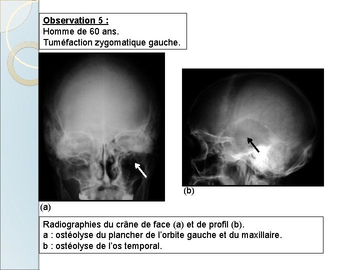 Observation 5 : Homme de 60 ans. Tuméfaction zygomatique gauche. (b) (a) Radiographies du