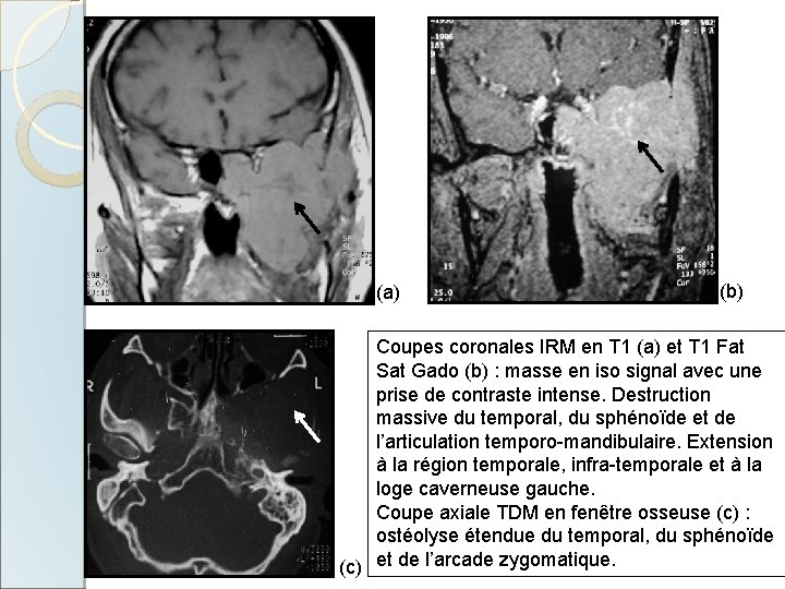 (a) (b) Coupes coronales IRM en T 1 (a) et T 1 Fat Sat