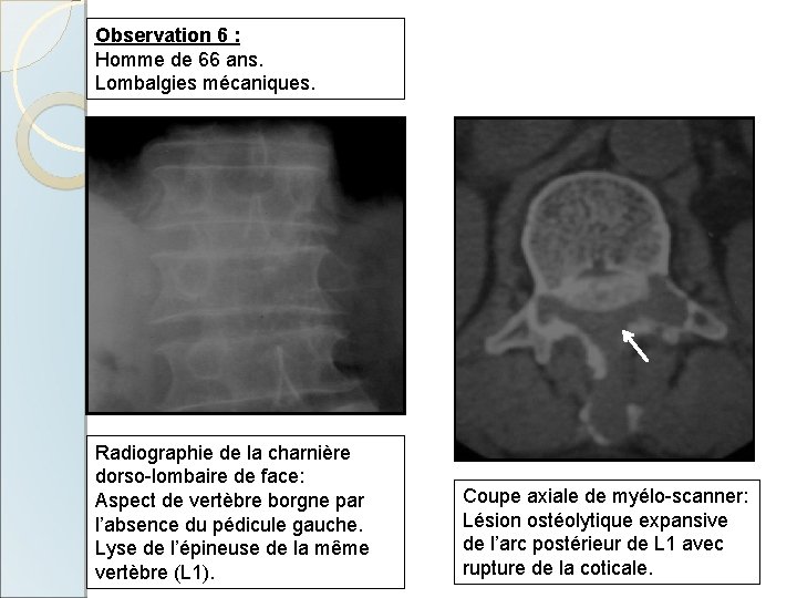 Observation 6 : Homme de 66 ans. Lombalgies mécaniques. Radiographie de la charnière dorso-lombaire