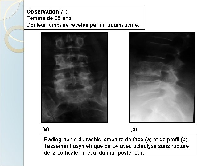 Observation 7 : Femme de 65 ans. Douleur lombaire révélée par un traumatisme. (a)