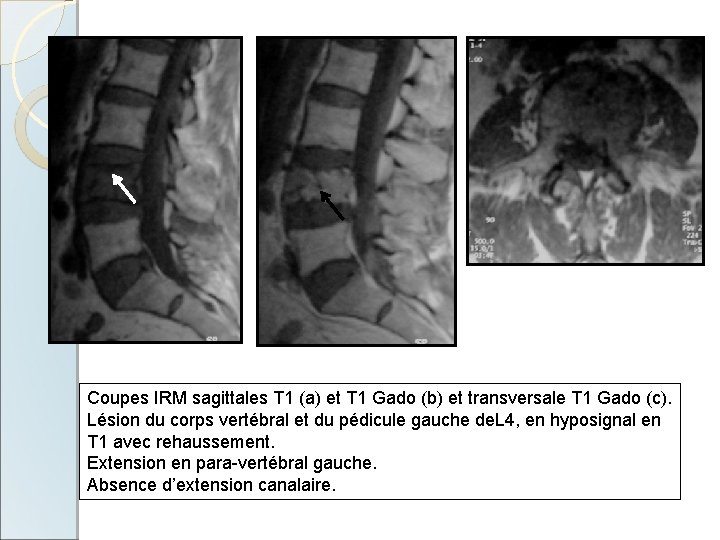 Coupes IRM sagittales T 1 (a) et T 1 Gado (b) et transversale T