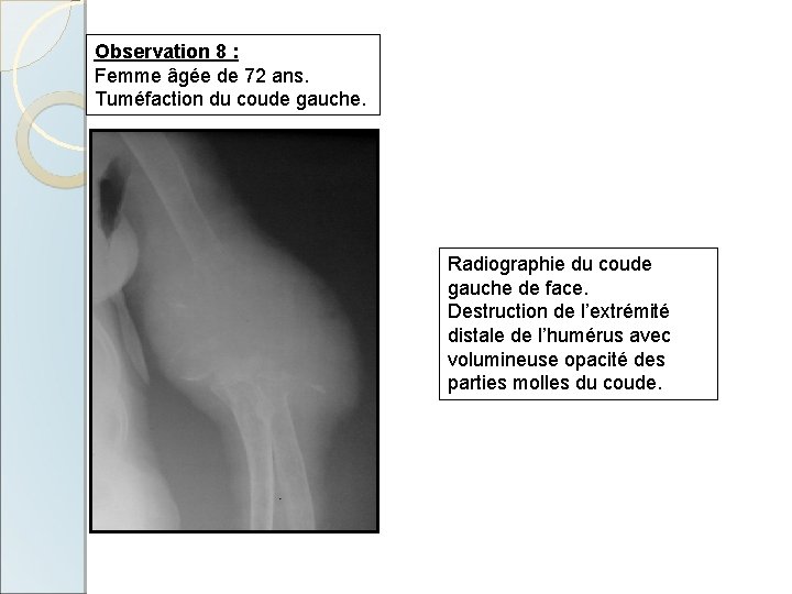 Observation 8 : Femme âgée de 72 ans. Tuméfaction du coude gauche. Radiographie du